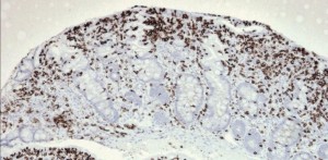 Refractory celiac disease immunohistochemistry (CD3+)