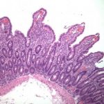Celiac Disease Pathogenesis III 300x288